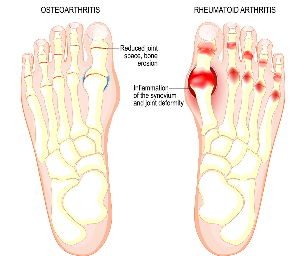 Big Toe Joint Arthritis: Causes, Symptoms, and Treatment Options