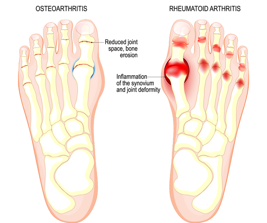 Big Toe Joint Arthritis: Causes, Symptoms, and Treatment Options